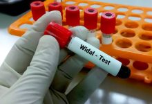 Widal Test কেন করা হয়